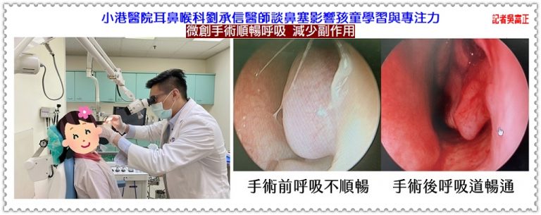 小港醫院耳鼻喉科劉承信醫師談鼻塞影響孩童學習與專注力 微創手術順暢呼吸 減少副作用＠華夏新聞報